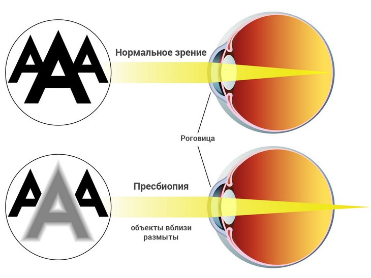 Пресбиопия и нормальное зрение